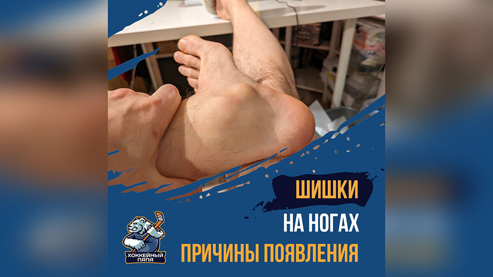 Шишки на ногах хоккеиста и причины появления